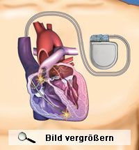 Der Herzschrittmacher im Körper